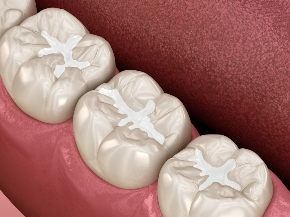 sealants 3d example