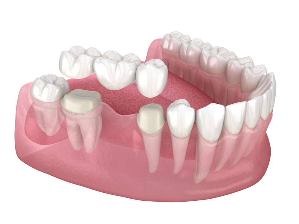 dental bridges 3d example