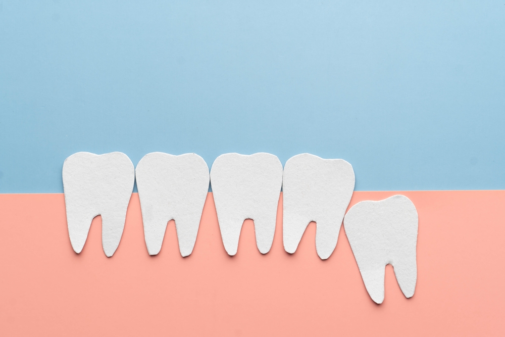 wisdom tooth example